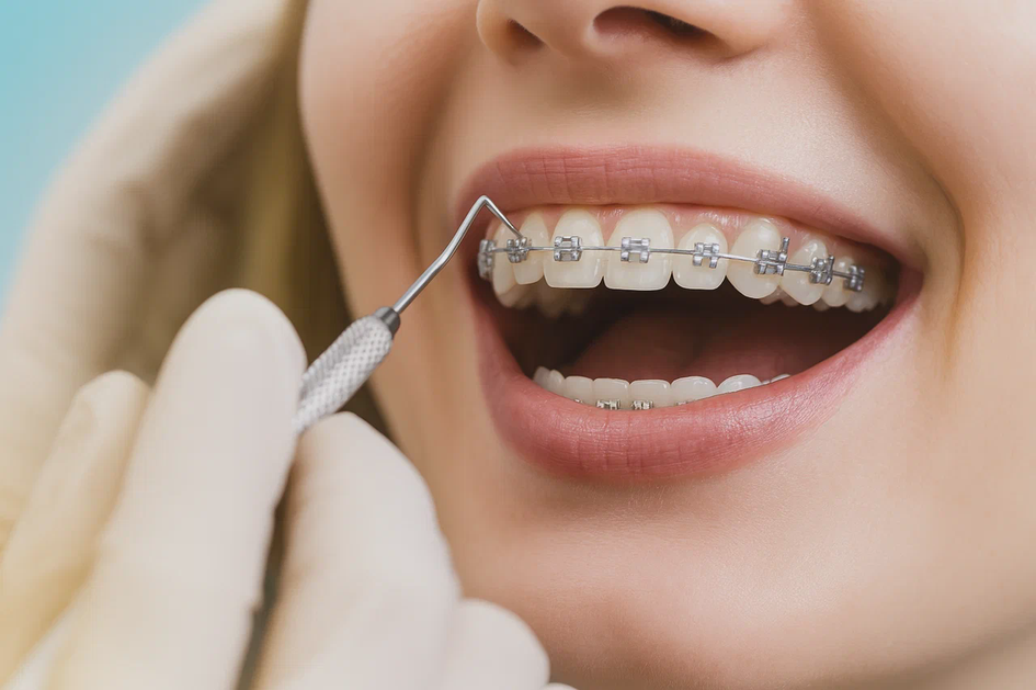 Og‘riqli va noqulay: breketlar haqidagi ko‘pchilik ishonadigan xato fikrlar